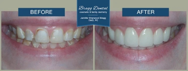 Close up of smile before and after treating discolored and slightly damaged teeth