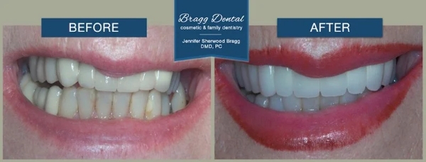 Close up of smile before and after fixing slightly discolored teeth