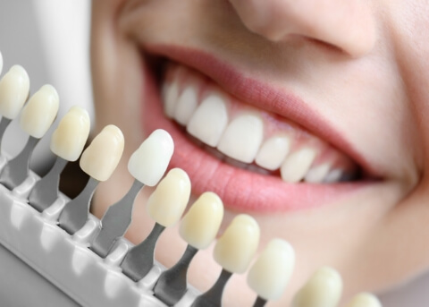 Close up of smile next to shade guide for dental veneers