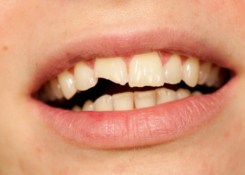 Close up of mouth with a broken upper front tooth
