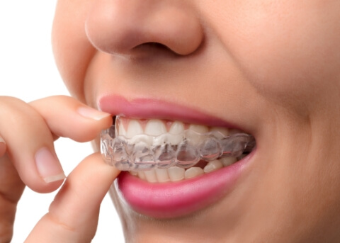 Close up of a person placing a clear aligner over their teeth