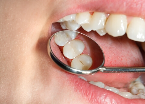 Close up of dental mirror in mouth reflecting teeth