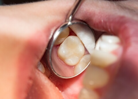 Close up of dental mirror in mouth reflecting a white tooth